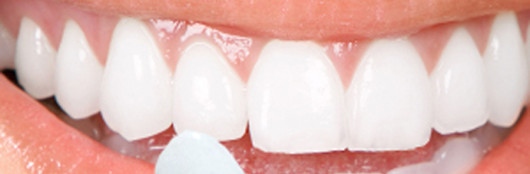Veneers